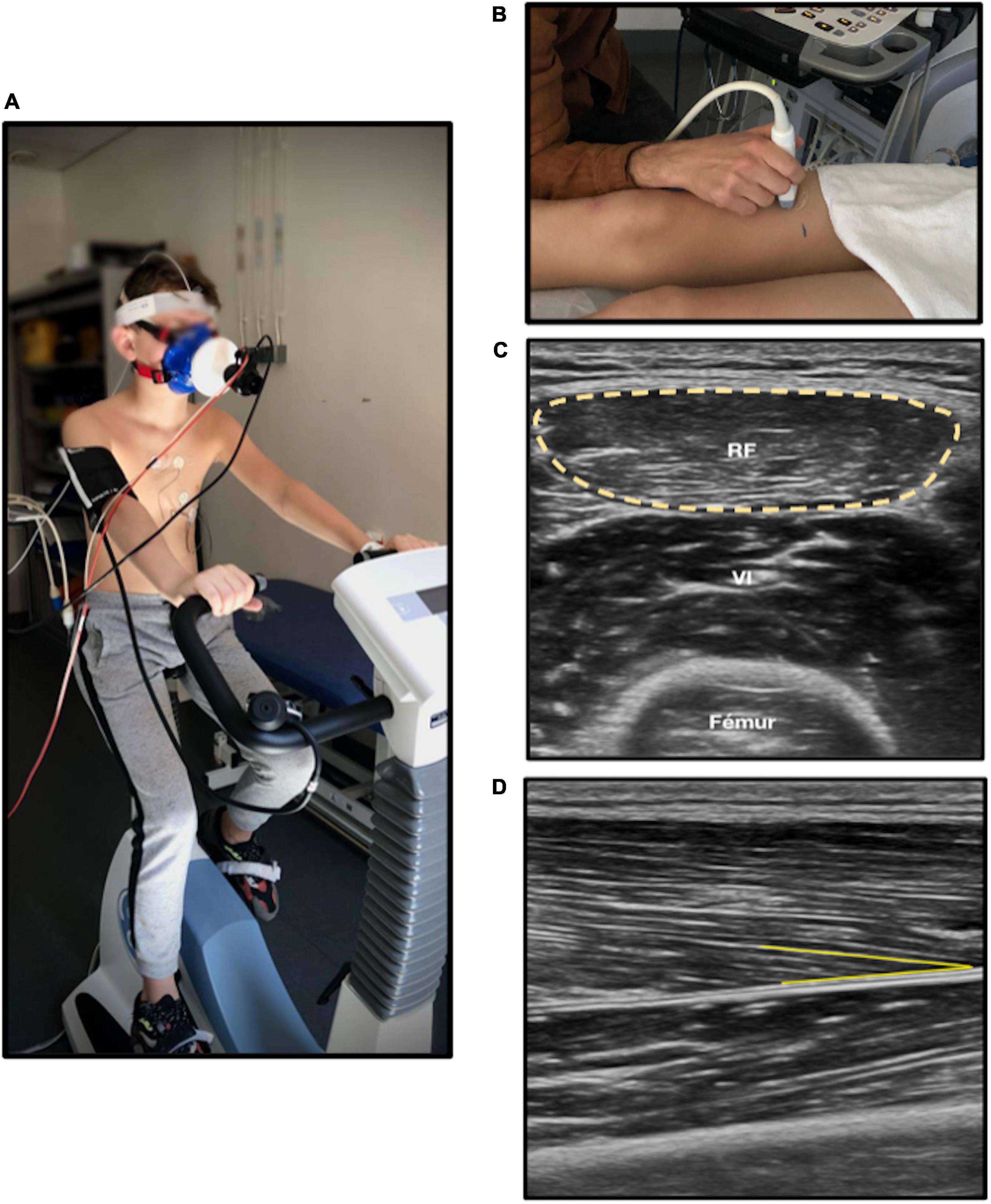 Cardiorespiratory fitness, muscle fitness, and physical activity in children with long QT syndrome: A prospective controlled study